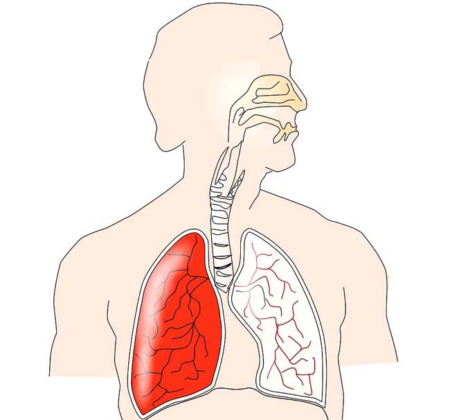 Rak płuc - objawy wczesne i późne - Nowotwory.org